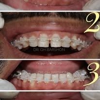 Orthodontics & Braces Treatment